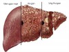 Viêm gan B có thể gây xơ gan, ung thư gan. Hình minh họa